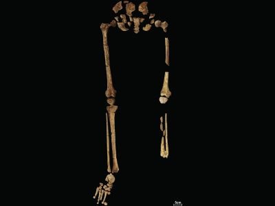 The uncovered skeleton shows where the lower left leg was amputated at the tibia and fibula.